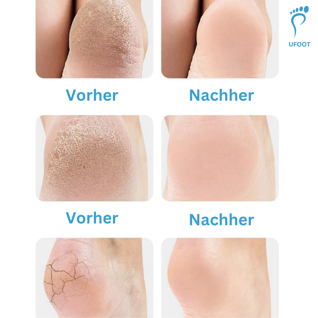Silikon-Fersensocken Fußpflege ufoot