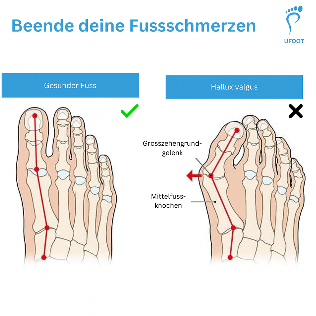 Zehentrenner SoftAlign ufoot