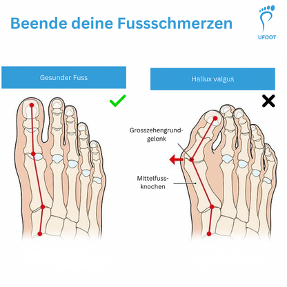 Zehentrenner SoftAlign ufoot